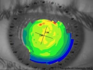 Topografía sin tratamiento de Orto-k